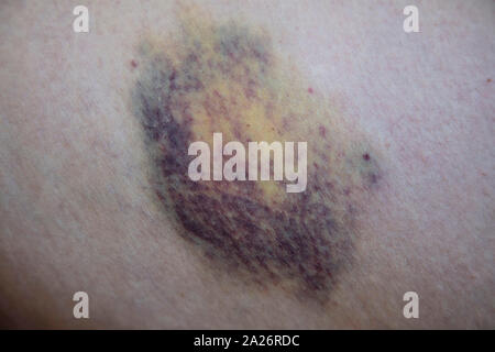 Close up d'un grand bleu sur une jambe de femme Banque D'Images