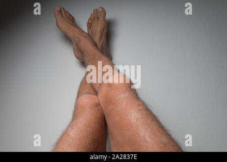 Grande plaque parapsoriasis sur caucasian man jambes Banque D'Images