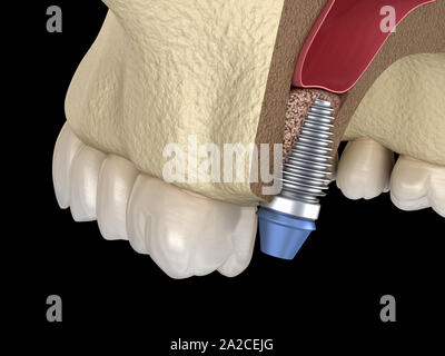 La chirurgie d'ascenseur de sinus - installation de l'implant. 3D illustration Banque D'Images
