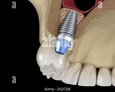 La chirurgie d'ascenseur de sinus - installation de l'implant. 3D illustration Banque D'Images