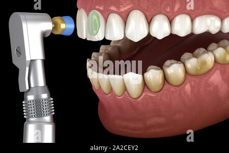 Procédure de polissage des dents avec brosse professionnelle et gel. Illustration 3D précis médicalement Banque D'Images