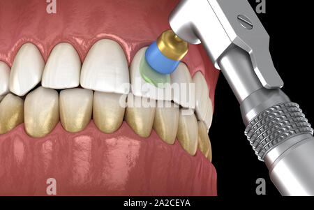 Procédure de polissage des dents avec brosse professionnelle et gel. Illustration 3D précis médicalement Banque D'Images