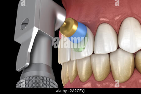 Procédure de polissage des dents avec brosse professionnelle et gel. Illustration 3D précis médicalement Banque D'Images