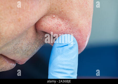 Close up man face avec whitehead boutons sur le nez, la maladie de l'acné. Banque D'Images