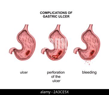 De l'oncologie. Ulcère. Complications : perforation et l'hémorragie Banque D'Images