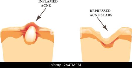 Inflammation de l'acné sur la peau. Bouton enflammés. La structure de la peau. La cicatrice d'acné. L'infographie. Vector illustration sur fond isolé. Illustration de Vecteur