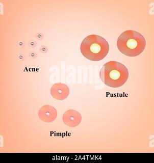 Types de points noirs, acné, pustules. La peau après l'acné cicatrices et l'acné. L'infographie. Vector illustration sur fond isolé. Illustration de Vecteur