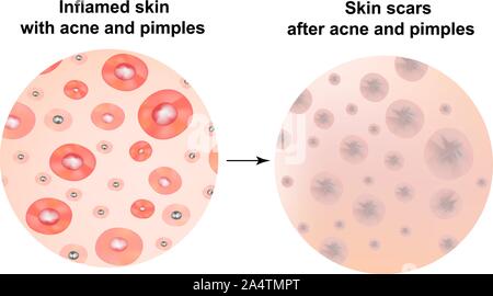 Types de points noirs, acné, pustules. La peau après l'acné cicatrices et l'acné. L'infographie. Vector illustration sur fond isolé. Illustration de Vecteur