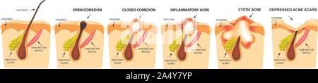 Types d'acné. Les comédons fermés, comédons ouverts, à l'inflammation de l'acné, kystes. L'inflammation des boutons. La structure de la peau. Cicatrice acné et boutons Illustration de Vecteur