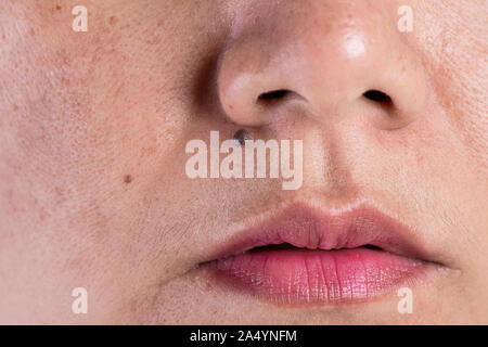 Femme avec un problème de la peau et des cicatrices d'acné. Problème de santé et soins de la concept. Les taches de rousseur melasma rides peau sèche et de pigmentation sur fac Banque D'Images