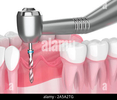 3D render of jaw avec forage gomme isolated over white Banque D'Images