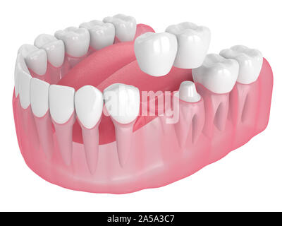 3D render of jaw avec dental pont cantilever sur fond blanc Banque D'Images