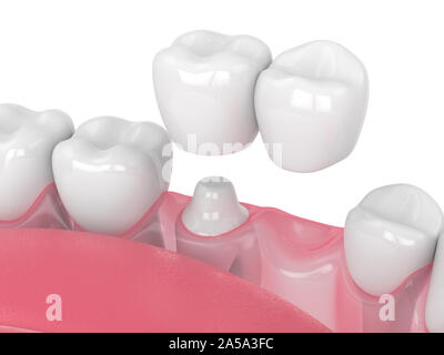 3D render of jaw avec dental pont cantilever sur fond blanc Banque D'Images