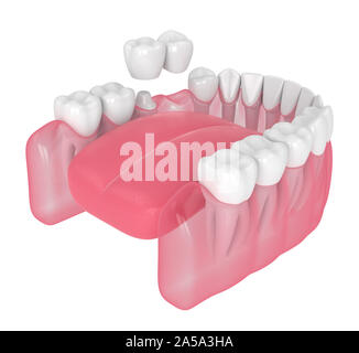 3D render of jaw avec dental pont cantilever sur fond blanc Banque D'Images