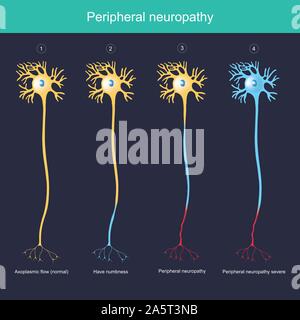 Neuropathie périphérique. Expliquer l'illustration pour la neuropathie périphérique ont un engourdissement jusqu'à une inflammation sévère. Illustration de Vecteur