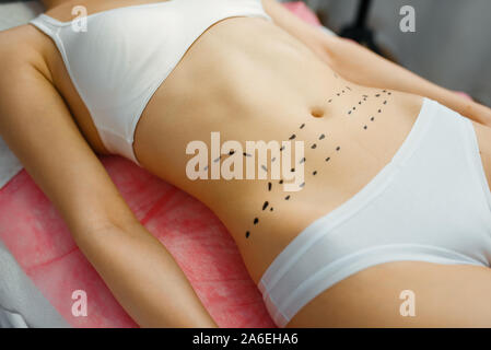Femme avec des marqueurs sur son abdomen, le botox Banque D'Images