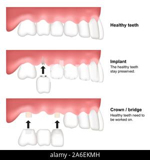 Remplacement de dents médicaux dentaires vector illustration isolé sur fond blanc Illustration de Vecteur