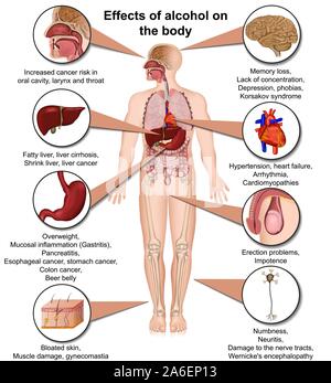 Effets de l'alcool sur le corps médical 3d vector illustration isolé sur fond blanc eps 10 Infographie Illustration de Vecteur