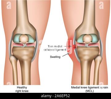 Entorse ligamentaire du genou médial vector illustration médicale isolé sur fond blanc infographie Illustration de Vecteur