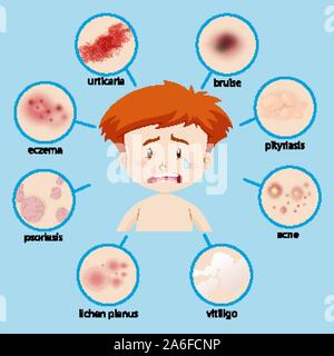 Schéma de l'boy avec différentes conditions de peau illustration Illustration de Vecteur