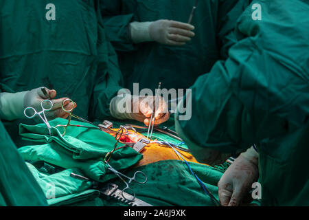 Close up groupe de chirurgiens en chirurgie salle d'opération. L'équipe médicale les chirurgiens de la chirurgie à l'hôpital faire fonctionner. Banque D'Images