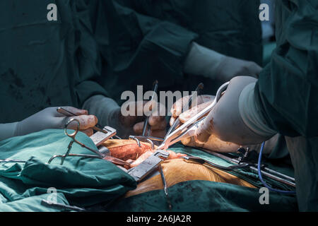 Close up groupe de chirurgiens en chirurgie salle d'opération. L'équipe médicale les chirurgiens de la chirurgie à l'hôpital faire fonctionner. Banque D'Images