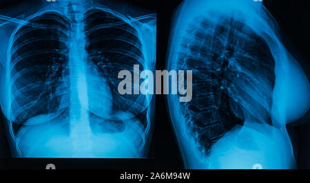 La radiographie pulmonaire en deux projections. Concept de prévention et de contrôle des maladies pulmonaires Banque D'Images