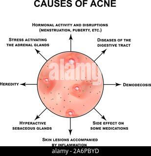 Les causes de l'acné. Pustules, papules, comédons, points noirs, l'acné sur la peau. L'infographie. Vector illustration sur fond isolé. Illustration de Vecteur