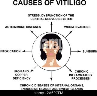 Causes de vitiligo. Journée mondiale de vitiligo. L'infographie. Vector illustration sur fond isolé. Illustration de Vecteur