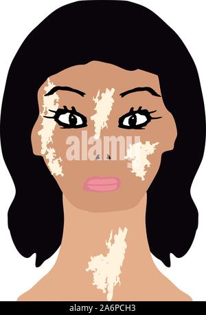 Journée mondiale de vitiligo. L'infographie. Vector illustration sur fond isolé. Illustration de Vecteur