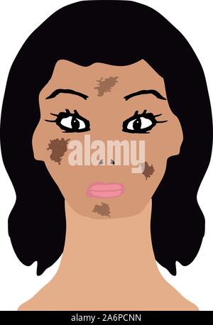 Visage avec pigmentation. Taches brunes sur la peau. L'infographie. Vector illustration sur fond isolé. Illustration de Vecteur