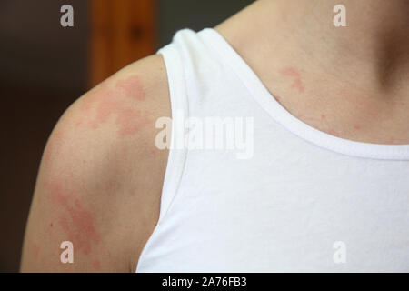 Sur une photo une dermatite allergique. La peau de la fille est surpris par une dermatite Banque D'Images