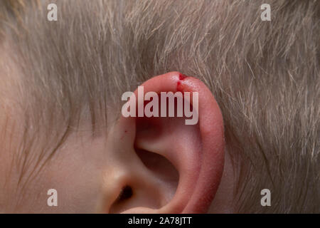 Dans la lacération d'un enfant. Une blessure à l'oreille du jeune bambin. Saignements frais oreillette rupture. Vue en gros plan. Medical, des blessures et de la douleur. Banque D'Images