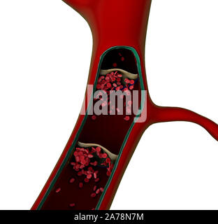 La contraction des vaisseaux sanguins, un caillot de sang dans les vaisseaux, les cellules de graisse dans le sang, à l'intérieur du vaisseau sanguin, de haute qualité de rendu 3D de cellules du sang Banque D'Images