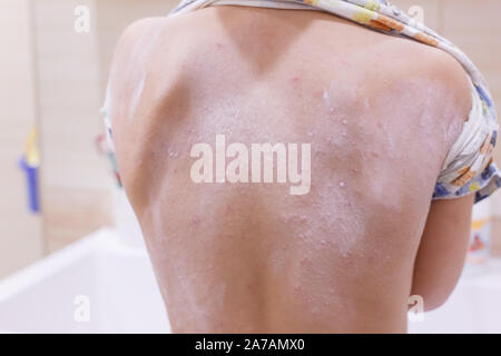 Le dos de l'enfant. Eczéma dermatite atopique symptôme peau. Crème émolliente Banque D'Images