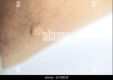 Masse pédiculés ou étiquette de peau ou acrochondon fibrome mou. Images du corps masculin bosse sur un plan macro sur la cuisse Banque D'Images