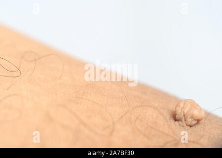 Masse pédiculés ou étiquette de peau ou acrochondon fibrome mou. Images du corps masculin bosse sur un plan macro sur la cuisse Banque D'Images