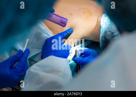 Close-up chirurgien burns une taupe sur le dos du patient. Procédure de chirurgie de déplacement de taupe. Banque D'Images