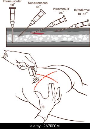 Illustration du vecteur d'injection intramusculaire et comparaison des angles d'injection intramusculaire Illustration de Vecteur