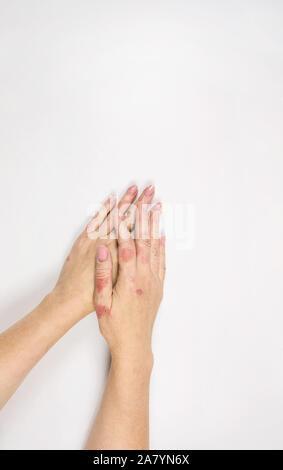 Les mains des femmes sont affectées par la dermatite. L'eczéma sur les mains. Close-up. Banque D'Images