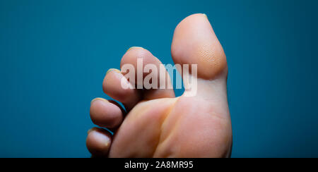 Extreme close up du pied d'athlète l'infection fongueuse vu de dessous Banque D'Images