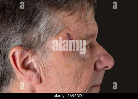 Mâle adulte senior avec coutures dans la coupe après la chirurgie pour enlever un carcinome baso-cellulaire causée par le soleil Banque D'Images