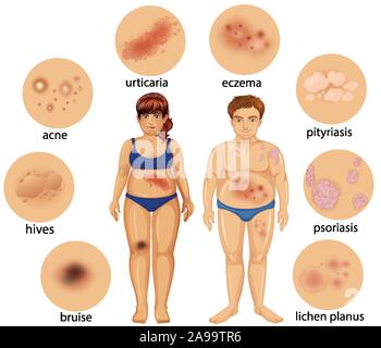 Schéma montrant les différentes maladies de peau illustration Illustration de Vecteur