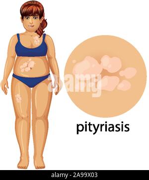 Femme avec pityriasis sur fond blanc illustration Illustration de Vecteur