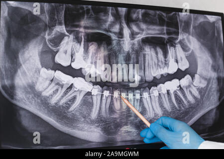 Médecin points à accolade dans dental x-ray Banque D'Images