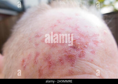 Front / tête et cuir chevelu d'un homme dont la kératose actinique lésions de la peau ( sun à long terme dommages à la peau causés par le rayonnement UV ) a été traité avec la crème Efudix pour tuer les cellules cancéreuses avant et peut-être. (114) Banque D'Images