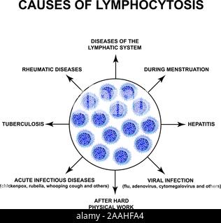 Causes de la lymphocytose. L'augmentation de lymphocytes dans le sang. Les tueurs de cellules. Les cellules d'aide de l'immunité. L'infographie. Vector illustration isolé sur Illustration de Vecteur