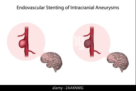 Un stent endovasculaire des anévrismes intracrâniens, illustration. Banque D'Images