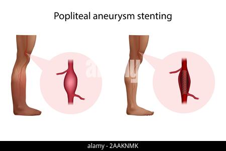 Anévrysme poplité stenting, illustration. Avant et après la chirurgie. Banque D'Images