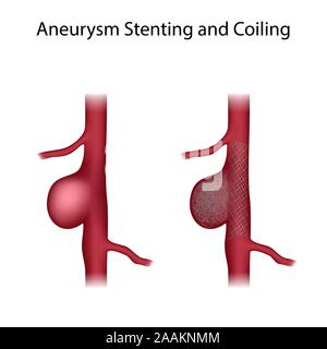 Le stenting de l'anévrisme et l'enroulement, l'illustration. Avant et après la chirurgie. Banque D'Images